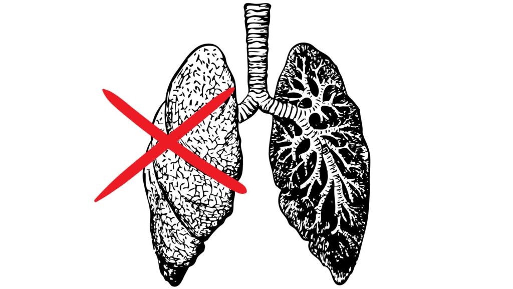 肺の病気のイラスト